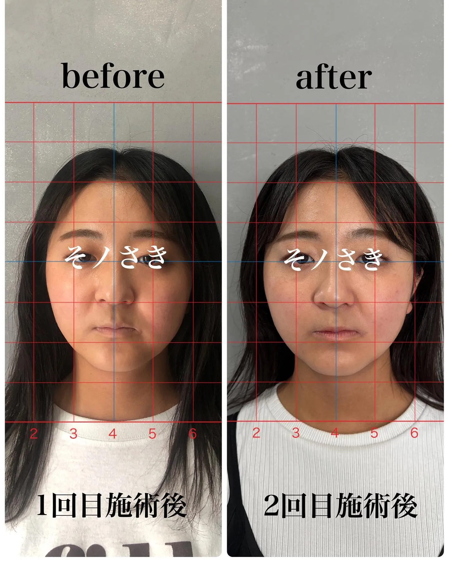🔥2回目の施術のビフォーアフター🔥